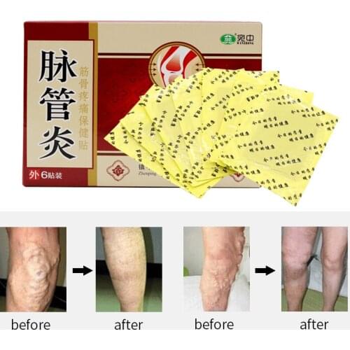 24PCS Chinese Traditional herbal medicine Patches Cure Spider Veins Varicose Treatment Plaster Varicose Veins Vasculitis Natural