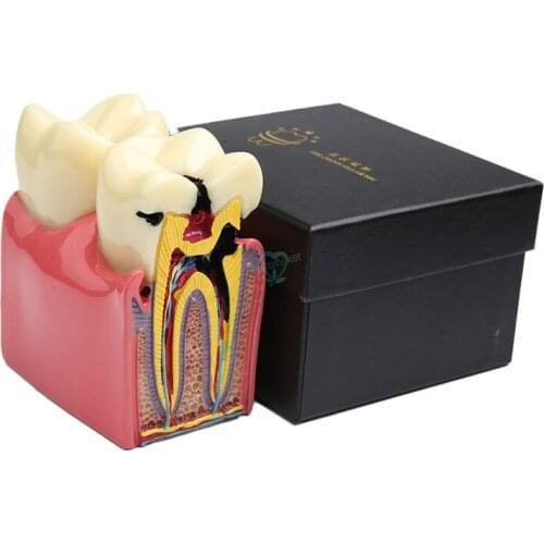 1Pcs Denture Caries Comparison Model Tooth Decay Model Dentist Pathologies For dental Teaching