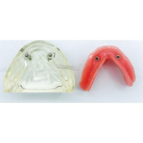 Two types of doctor-patient teaching models with explants for removable mandibular denture models