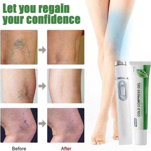 Varicose Veins Treatment Cream Blue Light Treatment Pen Vasculitis Phlebitis Spider Vein Eraser Treatments Ointment Cream
