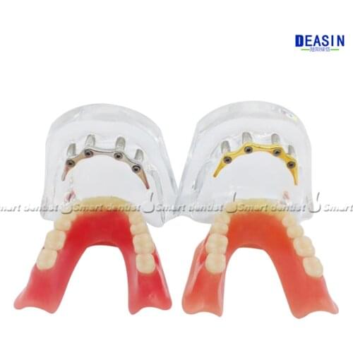 1 pc x high quality Resin Coverage dental implant model dentures Removable teeth model for dentist study Deasin dentistry