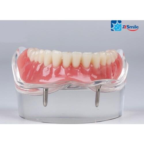 M6002 Overdenture Inferior model with 2 implant/Dental Demonstration Model