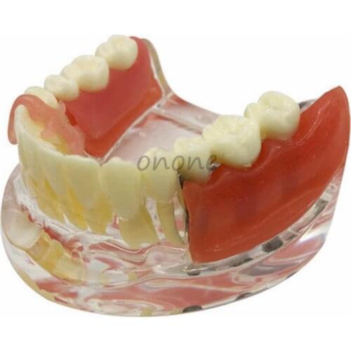 1pcs Mandibular Implant Restoration Teeth Model Silicone Soft Gum Removable