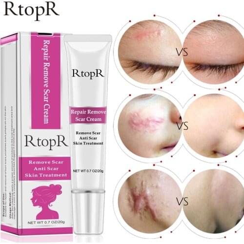 Acne Scar Stretch Marks Remover Cream Skin Repair Face Cream Acne Spots Acne Treatment Blackhead Cream