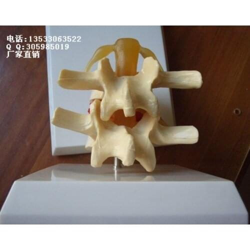 Vertebral Compression Demo Model Medical Human specimens model free shipping