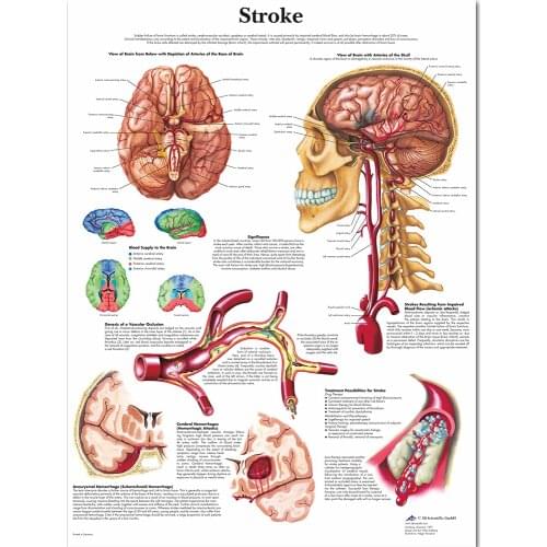 Anatomy of Brain in Stroke Anatomical Chart Neurological Posters Pathology Canvas Wall Pictures for Medical Education Home Decor