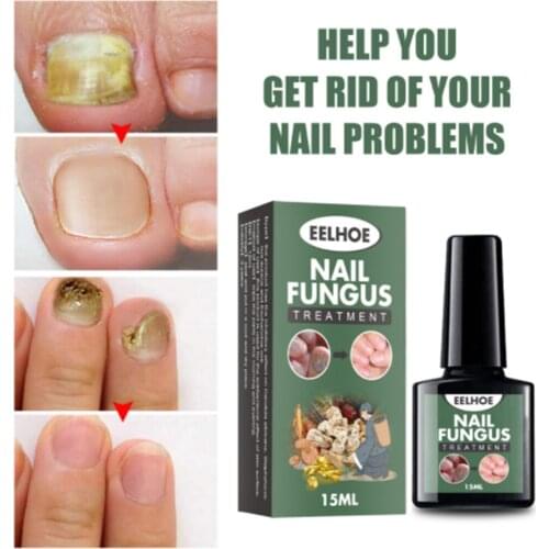 Nail Repair Liquid Nail Fungus Removal Anti Onychomycosis Feet Care Treatment With Foot File Nail Repair Liquid