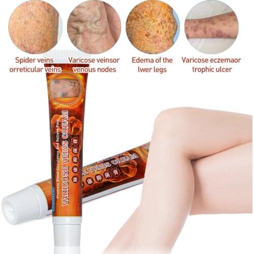 Varicosity Angiitis Remedy Ointment Relief Veins Pain Varicose Veins Treatment Cream Phlebitis Legs Varicose Veins Cream