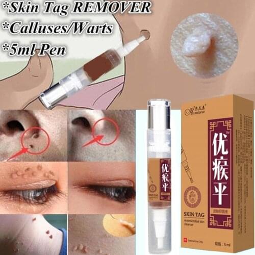 5ml Ultra Strength Skin Tag Remover 12 hours Tu kill Medical Tu kill Remover Foot Corn Skin Tag Mole & Genital Wart Remover