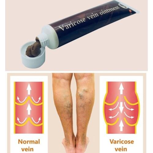 Varicose Veins Treatment Cream Effective Cure Vasculitis Phlebitis Spider Veins Pain Varicosity Angiitis Ointment Health Care