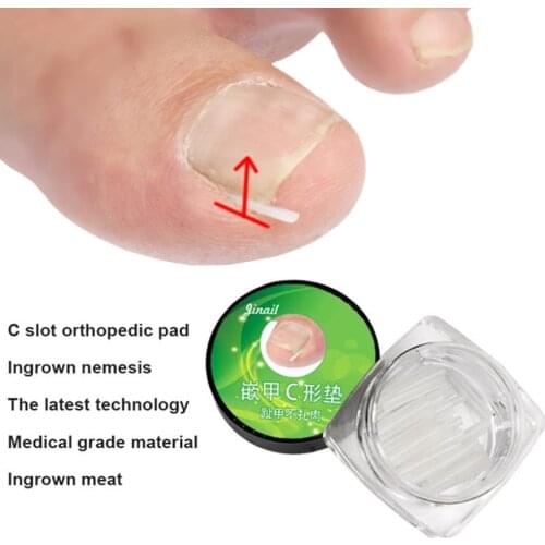 10pcs Ingrown Toenail Correction Pad Nail Filling Groove Pads Ingrown Nail Straightening Fixer Paronychia Recovery Pedicure Tool