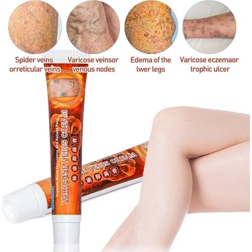 1Pcs 20g Varicose Veins Ointmnet Vasculitis Phlebitis Spider Cream Varicosity Angiitis Removal Herbal Medical Plaster