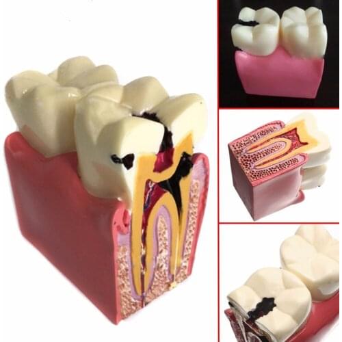 Laboratorio Dental Anatomy Education Teeth Model 6 Times Caries Comparation Demonstration Model for Dentist Studying Researching