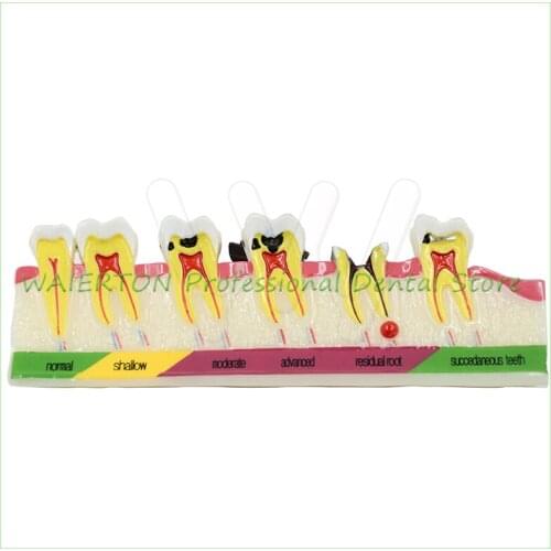 Dental Caries Developing illusteation Tooth Model Demonstration Teach Patient