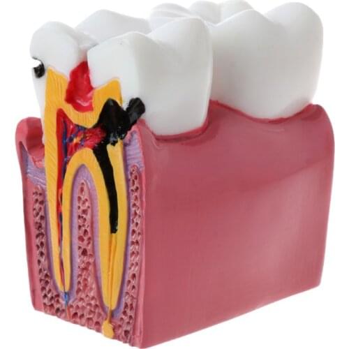 6 Times Dental Caries Comparation Anatomy Teeth Model for Dental Anatomy Lab Teaching Studying Researching Tool G88D