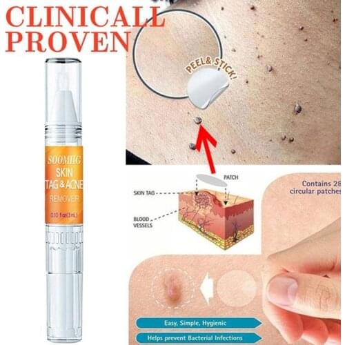 Natural Health Skin Tag Remover 12 Hours Tu Kill Medical Tu Mole Kill Tag Remover Skin R8E7