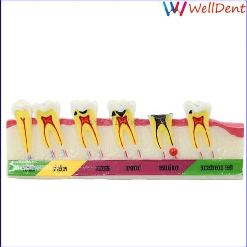 Dental Tooth teeth Model Caries Demonstration Teach Patient Developing illusteation