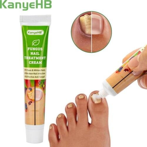1pcs Nail Fungus Treatment Cream Removal Nail Paronychia Onychomycosis Ointment Feet Whitening Toe Care Plaster G004