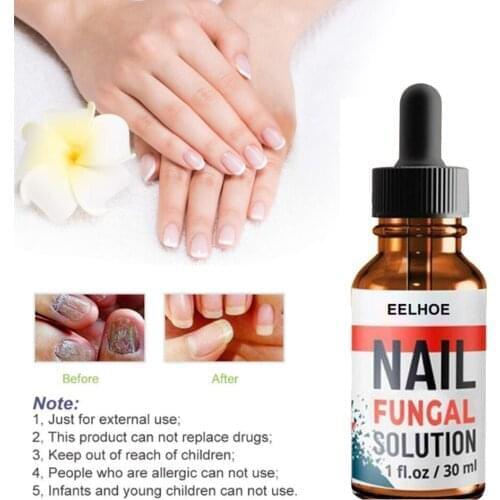 10ml/20ml/30ml Anti Fungal Treatment Fungus Effective Fingernail & Toenail Onychomycosis Paronychia Nail Infection Solution