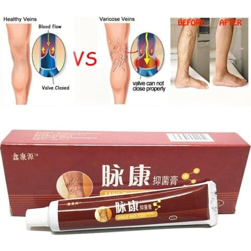Chinese Natural Herbal Medicine for Varicose Veins Ointment Vasculitis Inflammation Leg Massage Varicose Veins Cream