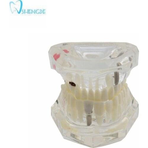 Dental Teeth Model Implant and Restoration Model Transparent Study Analysis Demonstration Teeth Model With Restoration Bridge