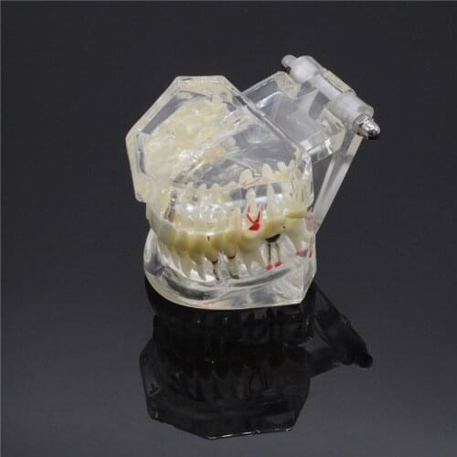 Dental Lab Implant Disease Tooth Dentures Model Pathological Extrusion Missing Teeth Model For Dentistry Study Teaching