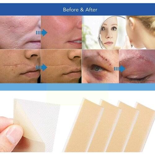 Beauty Scar Removal Sticker Silicone High-viscosity wounds Tone burns scars and Scar acne Skin Can eliminate Stic A8T6