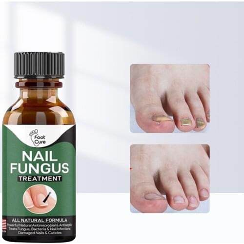 Fast Nail Fungal Treatments Nail Repair Essences Serum Care Treatments Foot Nail Fungus Removal Gel Paronychia Onychomycosis