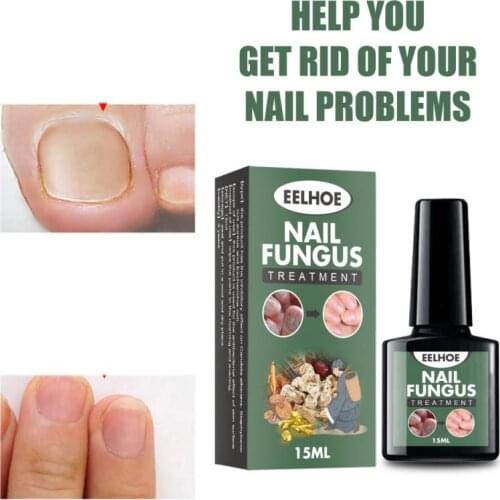 Nail Fungal Cure Nail Fungus Removal Liquid Nutritious Anti Paronychia Onychomycosis Foot Repair Fungal Nail Repair TSLM1