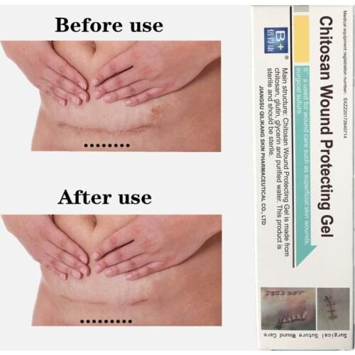 Effective Scar Removal Cream Remove Surgical Scars Stretch mark Removals Acne Scars Face Gel Body Skin Care Aichun New 1pcs