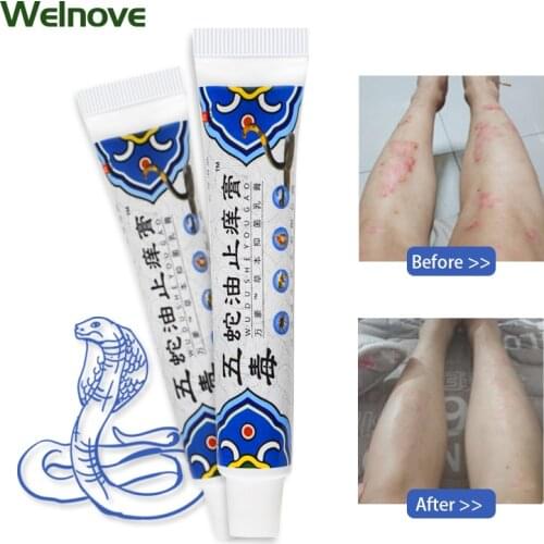 25g Snake Oil Cream Anti-Itching Antibacterial Psoriasis Eczema Cream Herbal Ointment Body Care Dermatitis Medical Plaster
