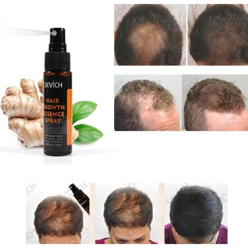 Hair Regeneration Essence Spray Effectively Prevent Baldness Spray Repair Scalp And Hair Follicles Hair Nutrition Liquid TSLM1