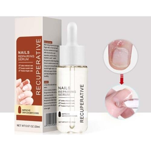 Nail Fungal Treatment Feet Care Essence Nail Foot Whitening Toe Nail Fungus Removal Gel Anti Infection Paronychia Onychomycosis