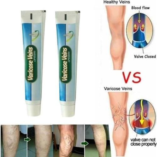 Varicose Veins Ointment Vasculitis Treatment Phlebitis Angiitis Inflammation Blood Vessel Rotten Legs Spider Treatment Cream