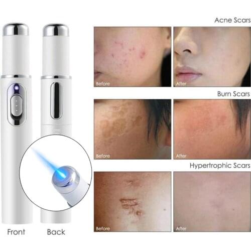 Blue Light Therapy Varicose Veins Treatment Laser Pen Soft Scar Wrinkle Removal Treatment Acne Laser Pen Massage Relaxing