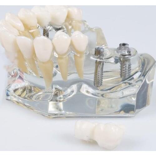 M2011 Implant Maxillary Dental Tooth Model with Implant and Crown Transparent Color