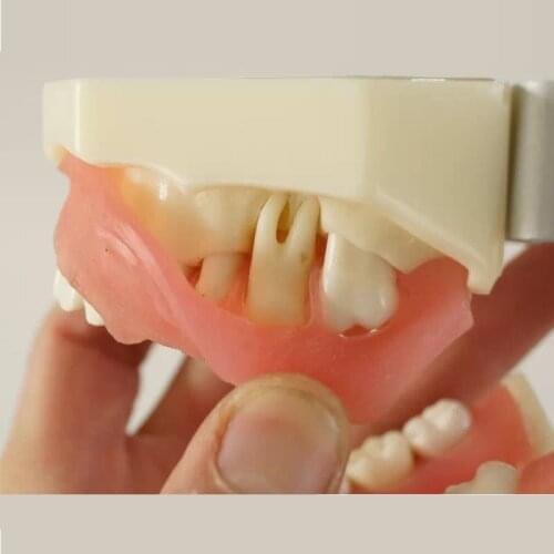 Dental Gingival disease model gum disease pathology teeth model