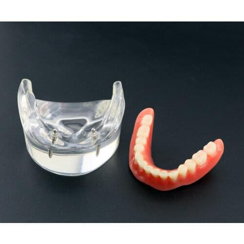 Dental Overdenture Inferior With 2 Implants Demo Model Study Model