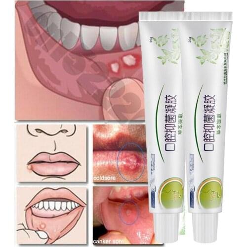 Mouth Ulcer Pain Relief Gel Natural Herbal Antibacterial Odor Oral Inflammation Bad Hygiene Cream Remove Irritation No Brea M8N3