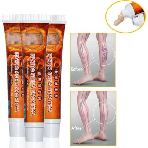 3pcs Hot Varicose Veins Treatment Cream Vasculitis Phlebitis Spider Leg Ointment Herb Medical Plaster Angiitis Removal Patch t33
