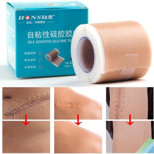 4x150cm Scar Band Removal Patches Silicone Gel Therapy Patch Acne Trauma Burn Scar Skin Repair Efficient Surgery Scar Treatment