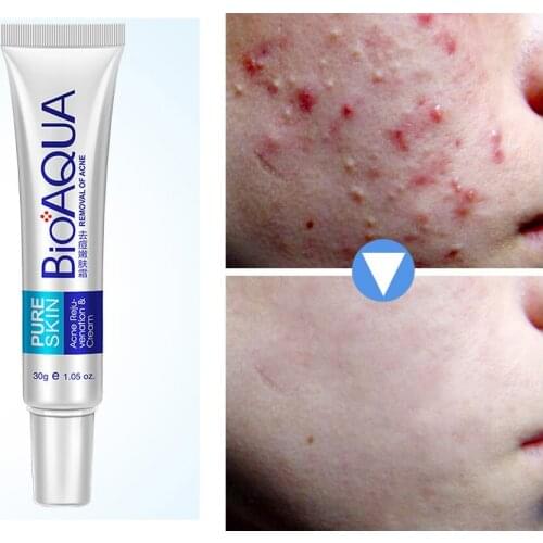 BIOAQUA treatment acne Cream for acne scars mark remover skin lightening Anti Acne face cream whitening to remove dark spots 20g