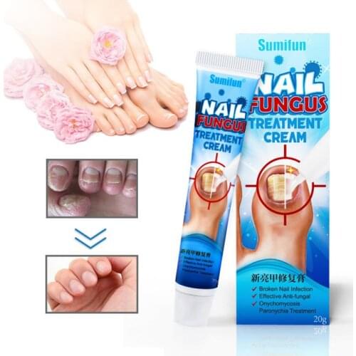 Sumifun Effective Nail Treatments Cream Nail Fungus Removal Cream Onychomycosis Paronychia Soft Nail Toenail Repair Ointment 20g