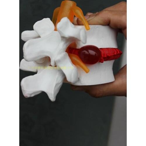 Free shipping 1pcs Human Lumbar Disc Herniation Model Demonstration Model of Lumbar Vertebral Model Orthopedic Model
