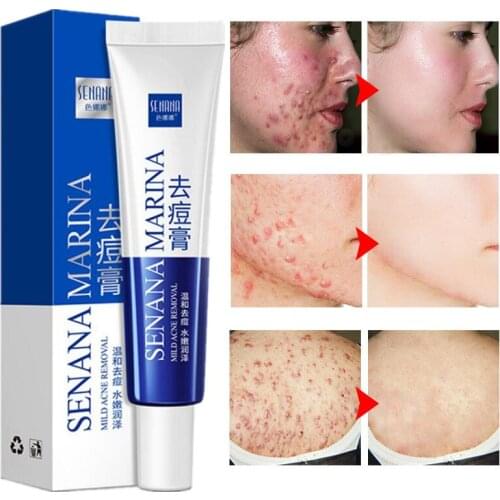 Effective Acne Removal Cream Acne Treatment Fade Acne Spots Oil Control Shrink Pores Whitening Moisturizing Acne Cream Skin Care