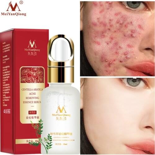 Centella Asiatica Acne Removal Essence Face Serum Liquid Moisturizing Anti Wrinkle Shrink Pores Oil-Control Whitening Face Care