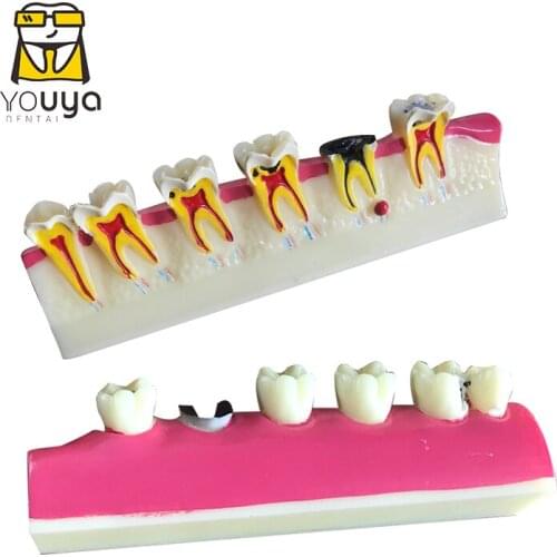 Model Of Periodontal Decay Progression Dental Teaching Demonstration Doctor-Patient Communication Model Studying Dental Diseases