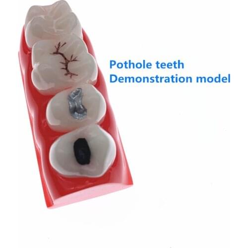 Teeth Model Dental pit and fissure closed model Treatment Teeth Model Used for dental teaching research models