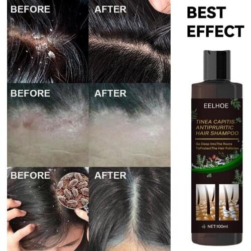 Hair Products 100ml Effective Anti-dandruff Hair Shampoo Lotion Universal Anti-dandruff Shampoo Mild Effect for Home Use