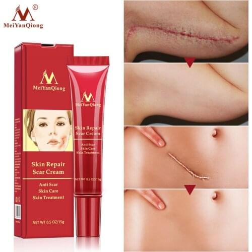 MeiYanQiong Removal Scar Repair Gel Face Cream Acne Spots Acne Treatment Anti Scar Stretch Marks Body Skin Cream 15g